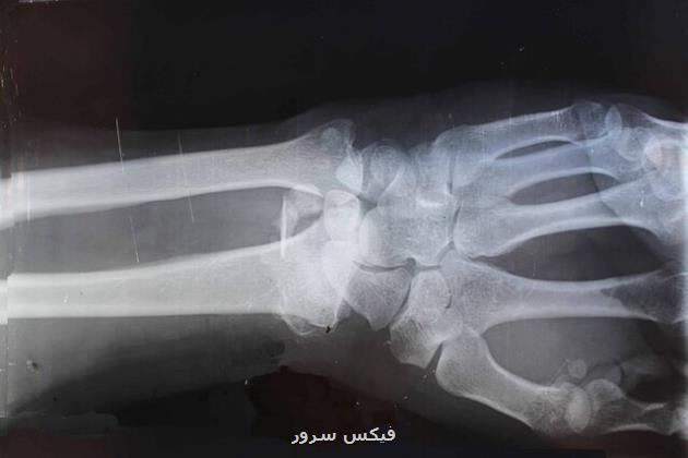روش جدیدی که به رشد استخوان کمک می کند