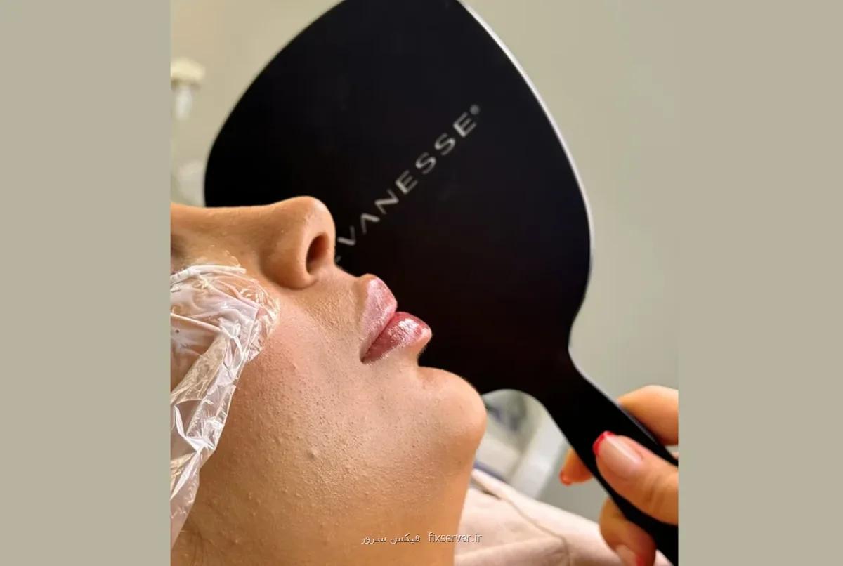 پروسه تزریق فیلر لب ایده آل