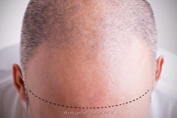 جلوگیری از ریزش مو با مسدود كردن انقباضات غلاف پوستی