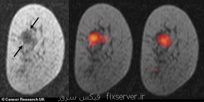نظارت بر تومورهای سرطانی با یك اسكن نوین