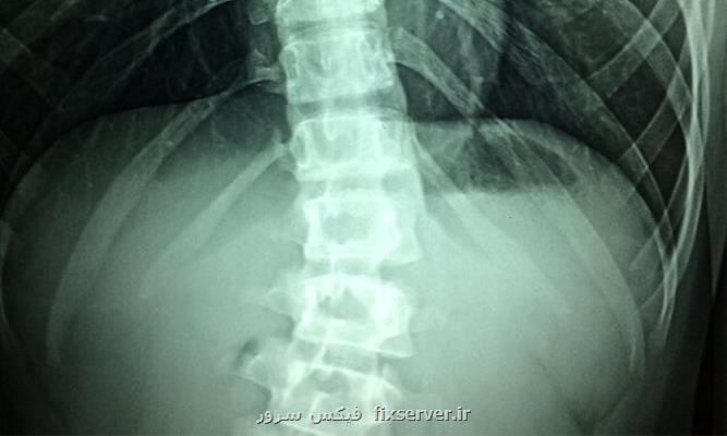 پروتئینی مهم برای ترمیم لطمه طناب نخاعی